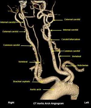 Normal CT angiogram Neck( aortic arch and carotids)