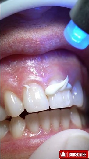 Beginning Tooth Damage – Early decay progression #dentaltransformation #dentist 1M views