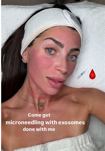 Step by step microneedling with exosomes healing results 💉🩸 @kazimiaesthetics #wellness #skincare #microneedling #exosomes #microneedlingbeforeandafter