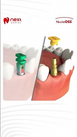 How to Position Impression Caps Correctly for Closed Tray Impressions | Dental Tip