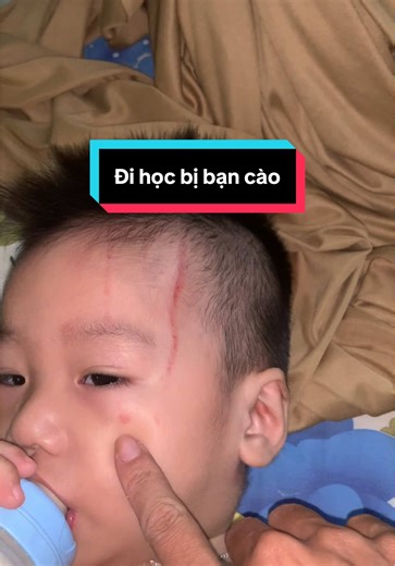 Con trai bị bạn cào: Làm gì để xử lý?