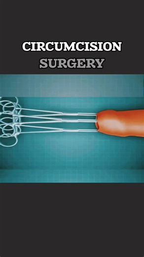 Circumcision Surgery Insights