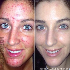 10 Things I Wish I Knew When I Had Bad Acne