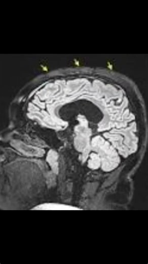 #foryou #medicalstudent #radiology #creatersearchingsight #radiographer MRI RF interferences Artifact