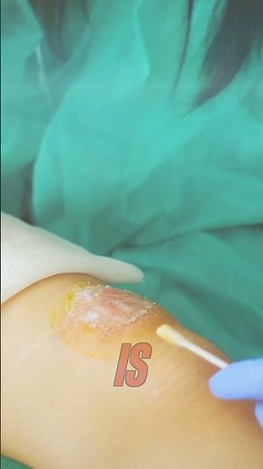 Does Silver Heal Your Wounds?