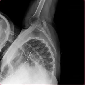 Shoulder :Axial Lateral View