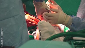 Hip replacement is a surgical procedure in which the hip joint is replaced by a prosthetic implant, that is, a hip prosthesis.