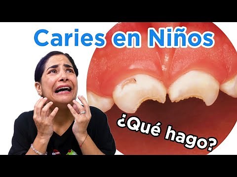 Caries en bebés | ¿Cómo se ven? ¿Cómo se previene?