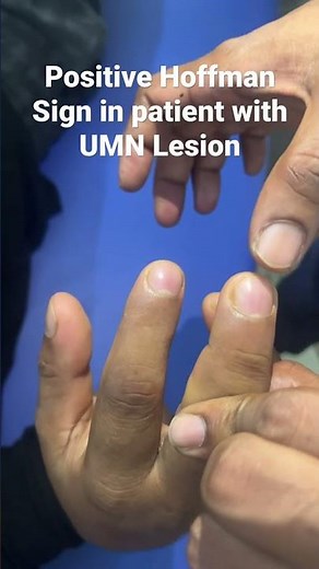 Positive Hoffman Sign in patient with UMN lesion
