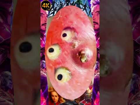 Blackheads Removal #228 | Acne Treatment and Very Satisfying Satisfying Pimple pop #blackheads