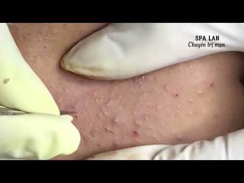 ACNE TREATMENT | Most Satisfying Pimple Popping Video Ever With Relaxing Spa Music