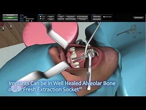 3D Dental Implant Surgical Simulator