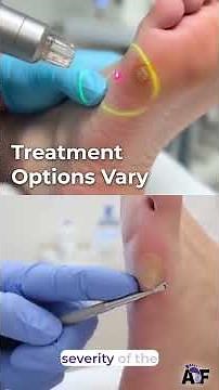 Expert Plantar Warts Treatment in Midtown Atlanta | Ankle & Foot Centers of America