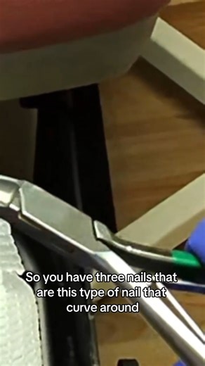 Dr Nail Nipper on Instagram: "Why Your Toenails Keep Pinching Your Skin (Curved Nail Explained) If your toenails curve inward and pinch the skin, you’re not alone 👣💙 These are called pincer (pincher) nails — a genetic nail shape that often worsens with age and can lead to pain or ingrown toenails. Watch how careful trimming protects sensitive skin and improves comfort! pincer nails, pincher toenails, curved toenails, toenail pain, ingrown toenails, sensitive feet, toenail trimming, foot care,