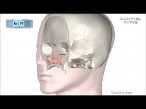 鼻中隔膜弯曲症／2分で分かる医療動画辞典 ミルメディカル