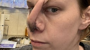Cocaine addict has slice of her HEAD grafted onto her nose after it collapsed