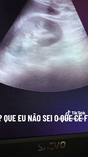 Icterícia: Sinais de Alerta e Causas Comuns
