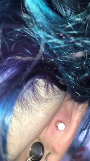 Dealing with Keloids: Understanding Tongue Piercings and Bumps