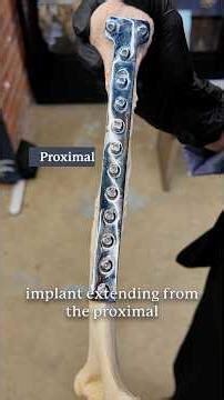 How Fracture Type Changes the Implant Design