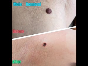 Congenital Nevus Removal (Shave Excision) - Full Procedure & Results