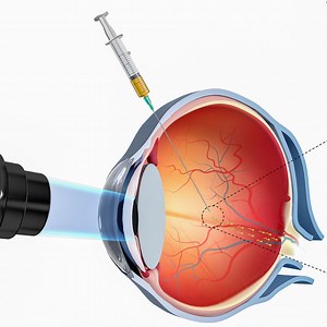 Kein Science Fiction: Nanoroboter erstmals durchs Auge gesteuert