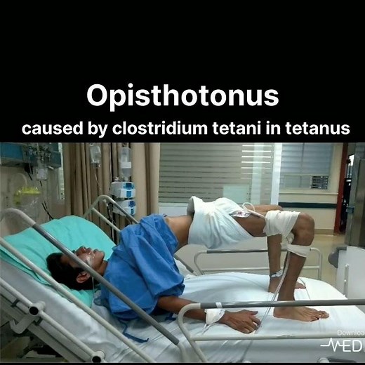 Opisthotonus caused by clostridium tetani in tetanus#doctor#viral #viralvideo #ankylosingspondylitis