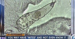 You might have eye mites and not even know it