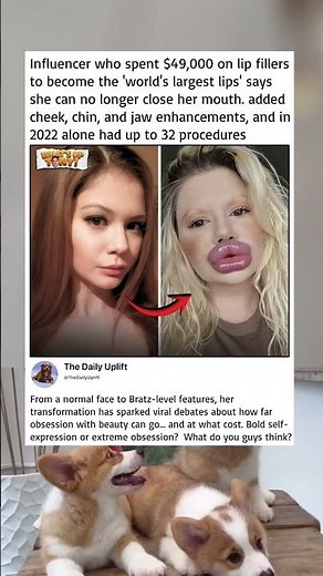 World’s largest lips? A $49,000 obsession with painful results.