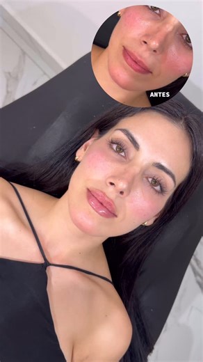 Dr. Carlos Cervantes on Instagram: "Mini Russian Lips 👄 Cantidad: 1 ml 💉 Duración: 8-10 meses 🕰️ Dolor: 5/10 🔥 Marca/Producto: Stylage M (COFEPRIS y FDA) Resultados Inmediatos ⏰ No se requiere reposo ❌ ¿Que te parece el resultado? 😉 #botox #russianlips #fillers #acidohialuronico #aestheticmedicine"