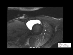 Les séquences de l'IRM cardiaque