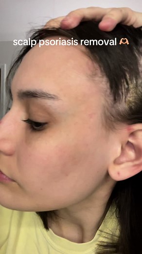 Effective Scalp Psoriasis Removal Techniques
