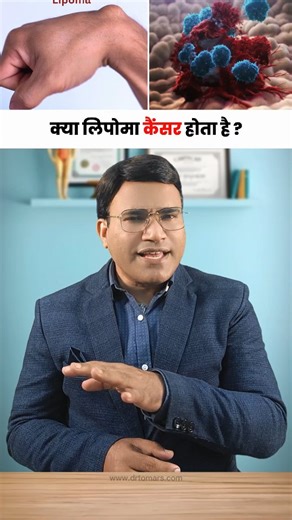 This is one of the most common questions people ask: Is Lipoma cancer? In this video, Dr. Tomar clearly explains the truth. 👉 Lipoma is a benign (non-cancerous) fatty lump 👉 It usually grows slowly and does not spread 👉 In most cases, Lipoma does not turn into cancer 👉 Medical evaluation is advised if a lump grows rapidly, becomes painful, or changes shape With proper diagnosis and Electro Homeopathy natural treatment, Lipoma can be managed safely without surgery. 📞 For Consultation & Medic