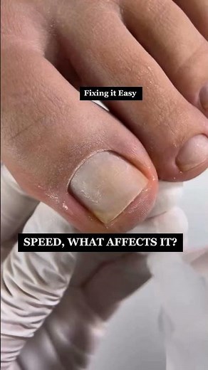 How to Fix Big Toe Nail Tutorial
