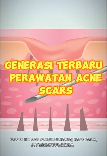 #generasiterbaruperawatanbopeng #treatmentbopengpondokindah