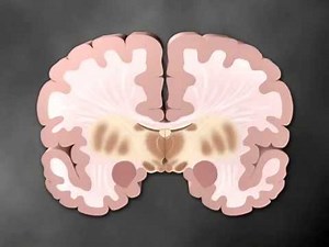 Parkinson's part 1 of 2 - Medical Animation by Watermark