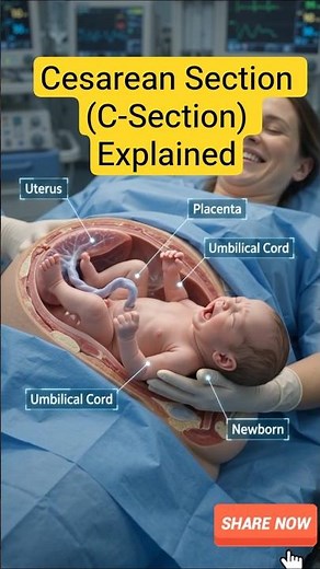 #CesareanSection (C-Section) Explained | #BabyDelivery #csectionbirth
