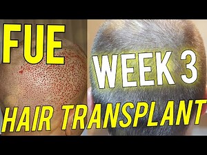 3500 grafts 3 weeks result FUE Hair Transplant - Growth, Shedding & Donor Area