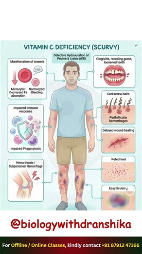 Vitamin C Deficiency (Scurvy): Signs, Symptoms & Prevention. #vitaminc #scurvy #vitamincdeficiency