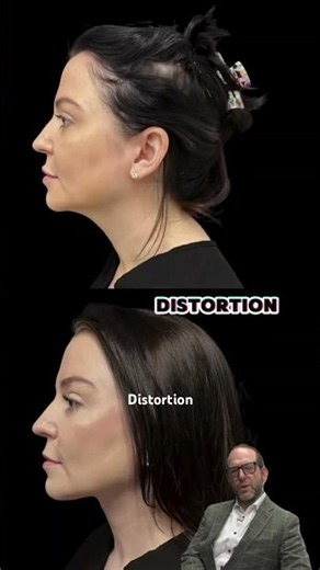 Not all deep plane facelifts are the same - Shape maters, Technique is paramount.