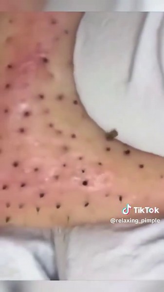 Tratamiento para puntos negros y acné