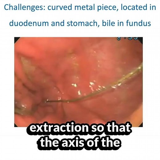 Gastrointestinal Foreign Body Extraction Demonstration