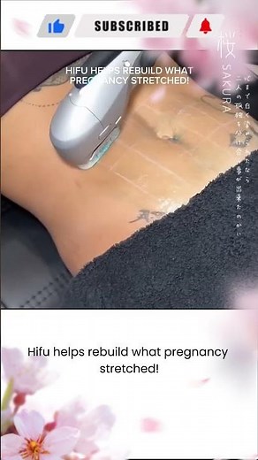 Tighten Your Tummy with Ultraformer HIFU | Post-Baby Confidence #HIFU #Ultraformer #bodysculpting