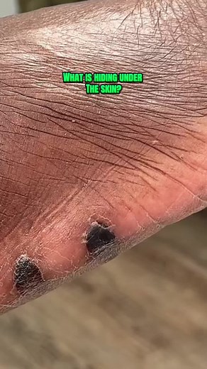 In diabetic patients, especially those with neuropathy (those who cannot feel properly or who have numbness and tingling.) there is an additional risk of a wound that can become infected. This is because if they cannot feel, when something is rubbing on their foot and causing problems, They may not know about it in a timely manner until it’s too late. In this situation, this patient presented with two abnormalities on her skin. There was a concern that there may be it won’t underneath. But thank