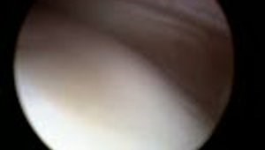 ARTHROSCOPIC AC RESECTION - THE MUMFORD PROCEDURE