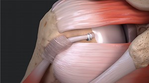 Loop ‘N’ Tack™ Biceps Tenodesis