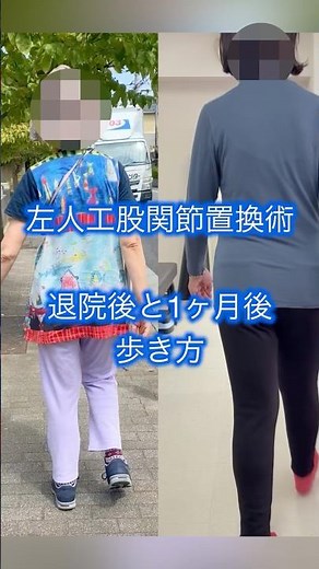 左人工股関節置換術 直後と1ヶ月後の歩行 #physioth #リハビリ