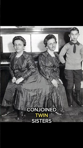 The Only Conjoined Twins to Give Birth to a Baby