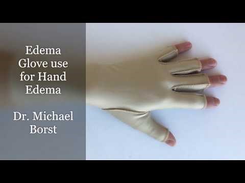 Compression Techniques for Edema: Edema Glove