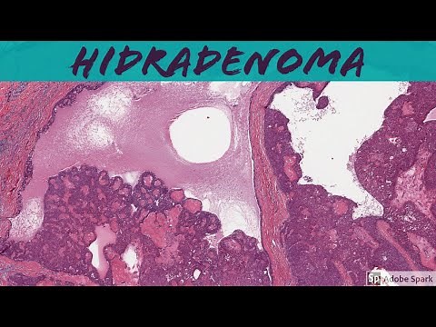 Nodular Hidradenoma (Acrospiroma): 5-Minute Pathology Pearls