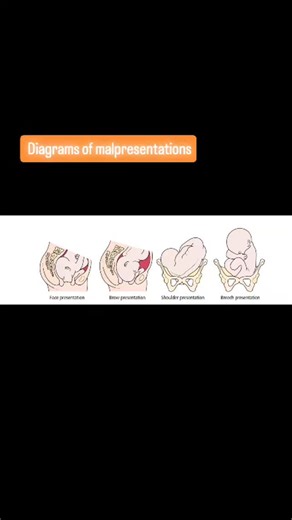 Radiology @all abnormalities 🥏🥏 | Diagrams of malpresentations | Instagram